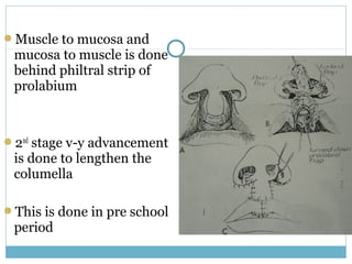 Muscle to mucosa and
mucosa to muscle is done
behind philtral strip of
prolabium
2nd
stage v-y advancement
is done to lengthen the
columella
This is done in pre school
period
 