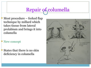 Repair of columella
Most procedure – forked flap
technique by millard which
takes tissue from lateral
prolabium and brings it into
columella
New concept
States that there is no skin
deficiency in columella
 