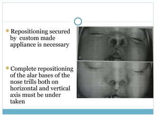Repositioning secured
by custom made
appliance is necessary
Complete repositioning
of the alar bases of the
nose trills both on
horizontal and vertical
axis must be under
taken
 