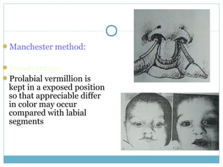 Manchester method:
Disadvantage:
Prolabial vermillion is
kept in a exposed position
so that appreciable differ
in color may occur
compared with labial
segments
 