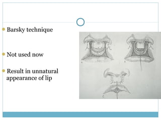 Barsky technique
Not used now
Result in unnatural
appearance of lip
 