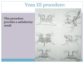Veau III procedure:
This procedure
provides a satisfactory
result
 