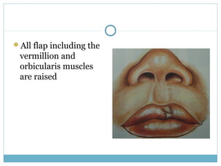 All flap including the
vermillion and
orbicularis muscles
are raised
 
