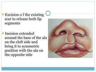 Excision o f the existing
scar to release both lip
segments
Incision extended
around the base of the ala
on the cleft side and
bring it to symmetric
position with the ala on
the opposite side
 