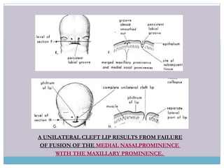 A UNILATERAL CLEFT LIP RESULTS FROM FAILURE
OF FUSION OF THE MEDIAL NASALPROMINENCE
WITH THE MAXILLARY PROMINENCE.
 