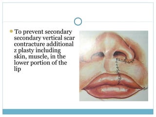 To prevent secondary
secondary vertical scar
contracture additional
z plasty including
skin, muscle, in the
lower portion of the
lip
 