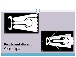 Kirch and Zhu-
Microclips
 