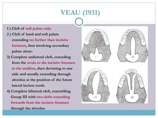VEAU (1931)
1 ) Cleft of soft palate only.
2 ) Cleft of hard and soft palate
extending no further than incisive
foramen, thus involving secondary
palate alone.
3) Complete unilateral cleft, extending
from the uvula to the incisive foramen
in the midline, then deviating to one
side and usually extending through
alveolus at the position of the future
lateral incisor tooth.
4) Complete bilateral cleft, resembling
Group III with two clefts extending
forwards from the incisive foramen
through the alveolus
 