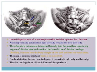  Lateral displacement of non-cleft premaxilla and tilts upwards into the cleft.
 Nasal septum and columella is bent laterally towards the non-cleft side .
 The orbicularis oris muscle is inserted laterally into the maxillary bone in the
region of the alar base and also into the lateral crus of the alar cartilage.
Medially, it inserts into the bony margin of the cleft and into the nasal spine.
 The nose is asymmetrical and there is no nostril sill.
 On the cleft side, the alar base is displaced posteriorly, inferiorly and laterally.
 The alar cartilage is usually unfolded and droops down .
 