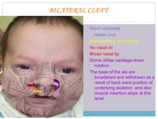 BILATERAL CLEFT
Short columella
medial crus
Malinsertions of muscles
No nasal sil
Broad nasal tip
Dome ofAlar cartilage-down
rotation
The base of the ala are
broadened and withdrawn as a
result of back ward position of
underlying skeleton and also
muscle insertion stops at this
level
 
