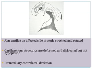 Alar cartilae on affected side is ptotic streched and rotated
Cartilagenous structures are deformed and dislocated but not
hypoplastic
Premaxillary contralatral deviation
 
