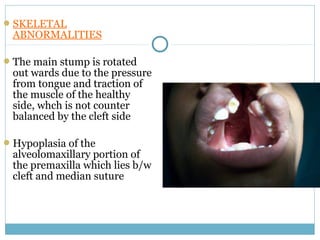 SKELETAL
ABNORMALITIES
The main stump is rotated
out wards due to the pressure
from tongue and traction of
the muscle of the healthy
side, whch is not counter
balanced by the cleft side
Hypoplasia of the
alveolomaxillary portion of
the premaxilla which lies b/w
cleft and median suture
 