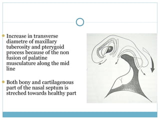 Increase in transverse
diametre of maxillary
tuberosity and pterygoid
process because of the non
fusion of palatine
musculature along the mid
line
Both bony and cartilagenous
part of the nasal septum is
streched towards healthy part
 