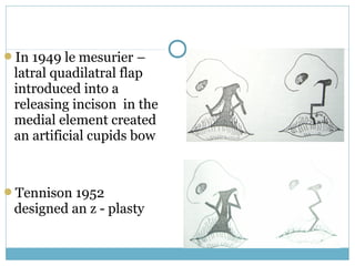 In 1949 le mesurier –
latral quadilatral flap
introduced into a
releasing incison in the
medial element created
an artificial cupids bow
Tennison 1952
designed an z - plasty
 