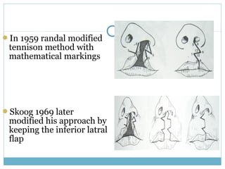 In 1959 randal modified
tennison method with
mathematical markings
Skoog 1969 later
modified his approach by
keeping the inferior latral
flap
 