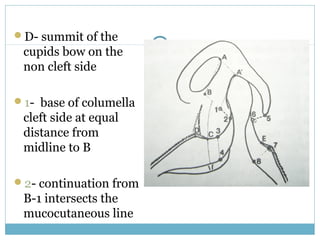 D- summit of the
cupids bow on the
non cleft side
1- base of columella
cleft side at equal
distance from
midline to B
2- continuation from
B-1 intersects the
mucocutaneous line
 