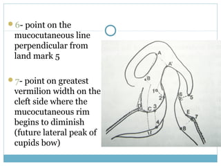 6- point on the
mucocutaneous line
perpendicular from
land mark 5
7- point on greatest
vermilion width on the
cleft side where the
mucocutaneous rim
begins to diminish
(future lateral peak of
cupids bow)
 