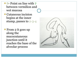 8- Point on line with 7
between vermilion and
wet mucosa
Cutaneous incision
begins at the inner
stump, passes to 2-3-4
From 2 it goes up
along the
mucocutaneous
junction until it
reaches the base of the
alveolar process
 