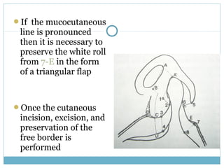 If the mucocutaneous
line is pronounced
then it is necessary to
preserve the white roll
from 7-E in the form
of a triangular flap
Once the cutaneous
incision, excision, and
preservation of the
free border is
performed
 