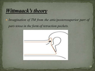  Invagination of TM from the attic/posterosuperior part of
pars tensa in the form of retraction pockets.
18
 