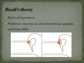  Basal cell hyperplasia
 Proliferate- infection, lay down keratinizing squamous
epithelium (KSE)
19
 
