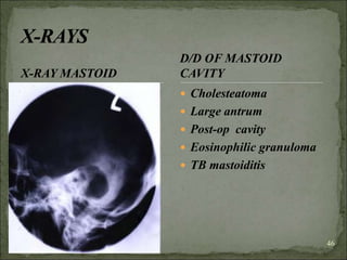 46
X-RAY MASTOID
 Cholesteatoma
 Large antrum
 Post-op cavity
 Eosinophilic granuloma
 TB mastoiditis
D/D OF MASTOID
CAVITY
 