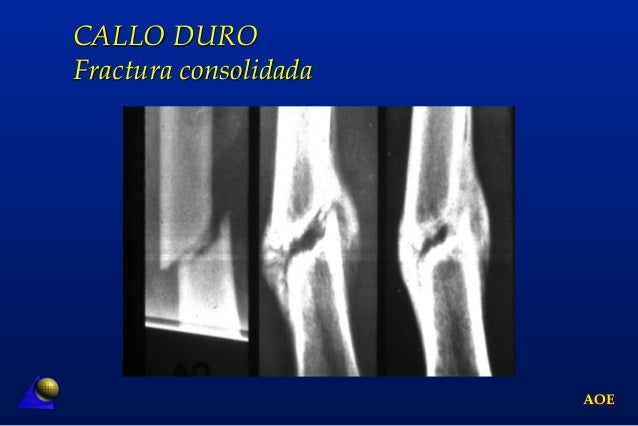 8 curacion osea DR. Miguel Mite