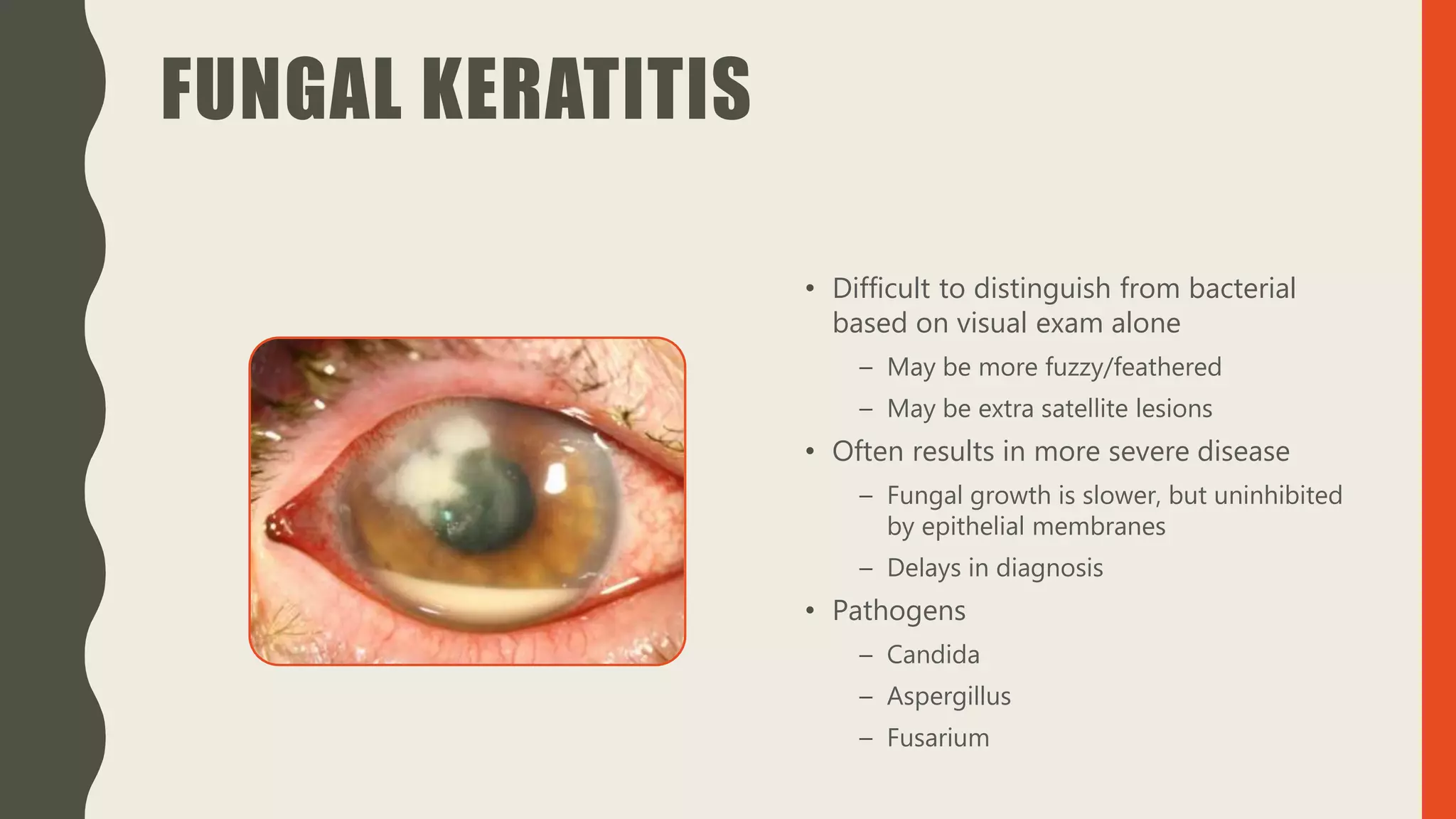 FUNGAL KERATITIS
• Difficult to distinguish from bacterial
based on visual exam alone
– May be more fuzzy/feathered
– May be extra satellite lesions
• Often results in more severe disease
– Fungal growth is slower, but uninhibited
by epithelial membranes
– Delays in diagnosis
• Pathogens
– Candida
– Aspergillus
– Fusarium
 