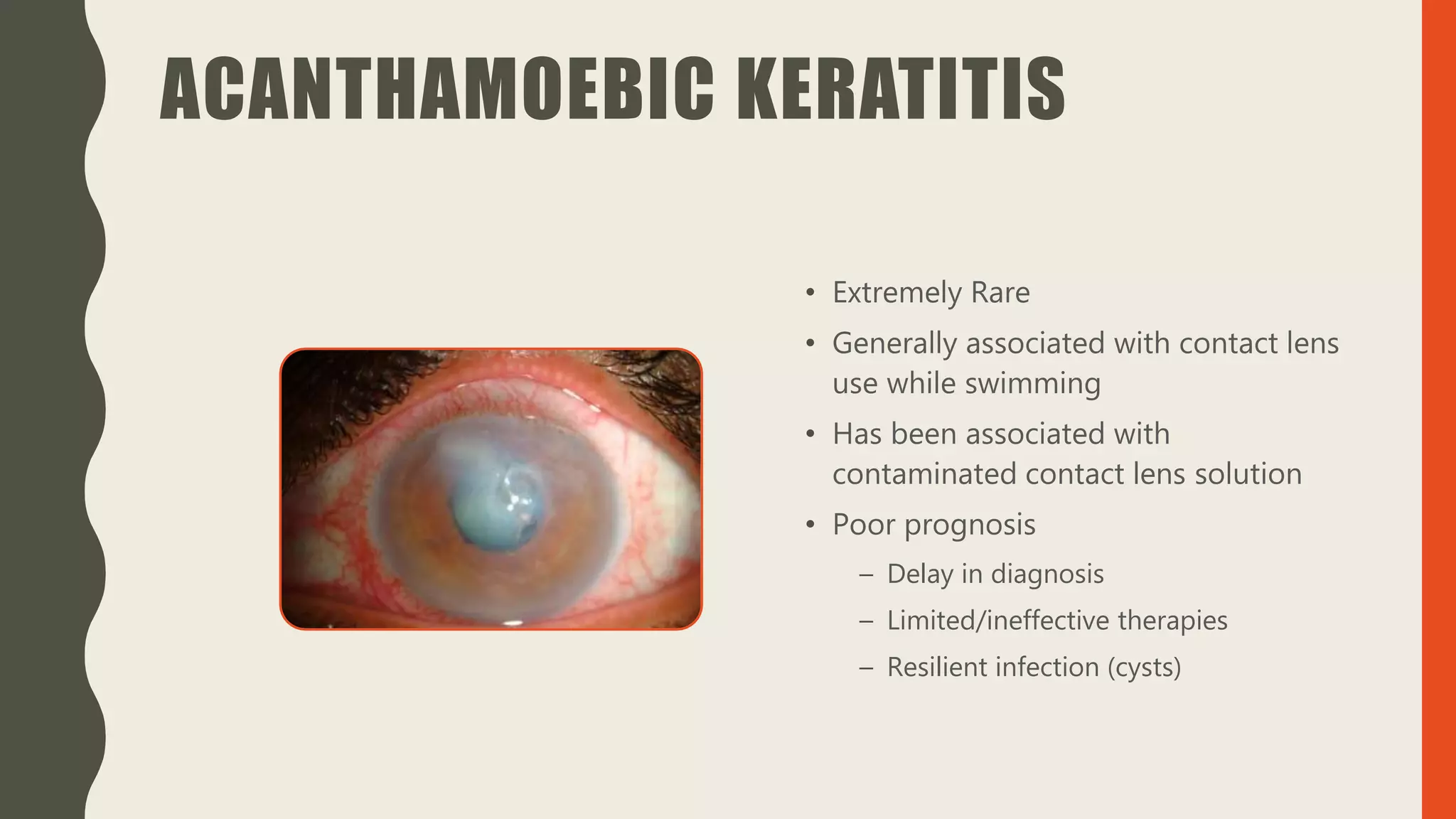 ACANTHAMOEBIC KERATITIS
• Extremely Rare
• Generally associated with contact lens
use while swimming
• Has been associated with
contaminated contact lens solution
• Poor prognosis
– Delay in diagnosis
– Limited/ineffective therapies
– Resilient infection (cysts)
 