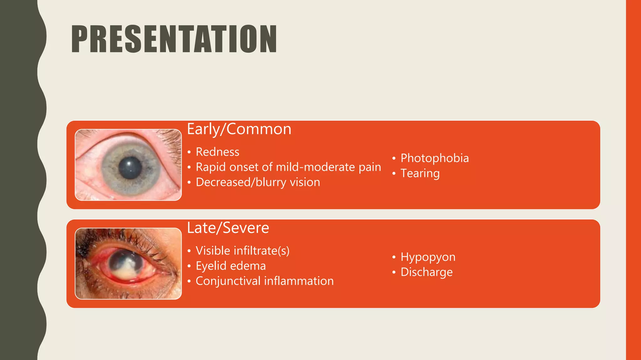 PRESENTATION
Early/Common
• Redness
• Rapid onset of mild-moderate pain
• Decreased/blurry vision
• Photophobia
• Tearing
Late/Severe
• Visible infiltrate(s)
• Eyelid edema
• Conjunctival inflammation
• Hypopyon
• Discharge
 