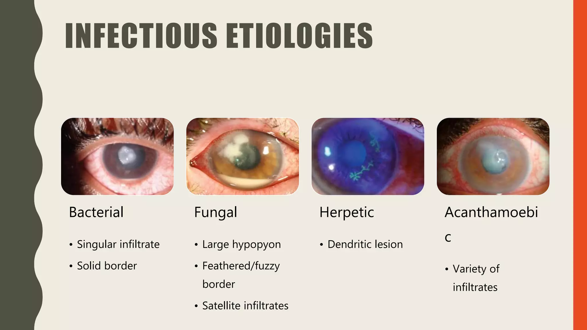INFECTIOUS ETIOLOGIES
Bacterial
• Singular infiltrate
• Solid border
Fungal
• Large hypopyon
• Feathered/fuzzy
border
• Satellite infiltrates
Herpetic
• Dendritic lesion
Acanthamoebi
c
• Variety of
infiltrates
 