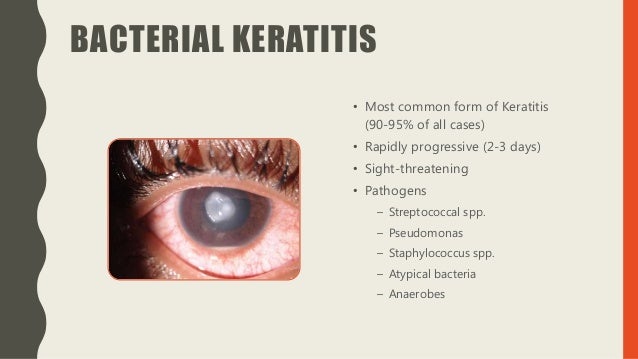 Keratitis