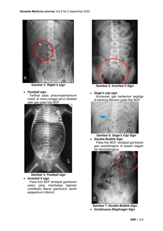 Ganesha Medicina Journal, Vol 2 No 2 September 2022
GMJ | 124
Gambar 3. Rigler’s sign
• Football sign
Terlihat pada pneumoperitoneum
masif, di mana rongga perut dibatasi
oleh gas pada foto BOF.
Gambar 4. Football sign
• Inverted V sign
Pada foto BOF terdapat gambaran
udara yang membatasi ligamen
umbilikalis lateral (pembuluh darah
epigastrium inferior).
Gambar 5. Inverted V Sign
• Doge’s cap sign
Kumpulan gas berbentuk segitiga
di kantong Morison pada foto BOF
Gambar 6. Doge’s Cap Sign
• Double Bubble Sign
Pada foto BOF, terdapat gambaran
gas subdiafragma di bawah bagian
kiri hemidiafragma
Gambar 7. Double Bubble Sign
• Continuous Diaphragm Sign
 