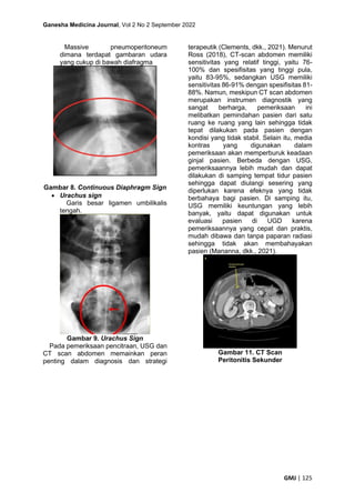 Ganesha Medicina Journal, Vol 2 No 2 September 2022
GMJ | 125
Massive pneumoperitoneum
dimana terdapat gambaran udara
yang cukup di bawah diafragma
Gambar 8. Continuous Diaphragm Sign
• Urachus sign
Garis besar ligamen umbilikalis
tengah.
Gambar 9. Urachus Sign
Pada pemeriksaan pencitraan, USG dan
CT scan abdomen memainkan peran
penting dalam diagnosis dan strategi
terapeutik (Clements, dkk., 2021). Menurut
Ross (2018), CT-scan abdomen memiliki
sensitivitas yang relatif tinggi, yaitu 76-
100% dan spesifisitas yang tinggi pula,
yaitu 83-95%, sedangkan USG memiliki
sensitivitas 86-91% dengan spesifisitas 81-
88%. Namun, meskipun CT scan abdomen
merupakan instrumen diagnostik yang
sangat berharga, pemeriksaan ini
melibatkan pemindahan pasien dari satu
ruang ke ruang yang lain sehingga tidak
tepat dilakukan pada pasien dengan
kondisi yang tidak stabil. Selain itu, media
kontras yang digunakan dalam
pemeriksaan akan memperburuk keadaan
ginjal pasien. Berbeda dengan USG,
pemeriksaannya lebih mudah dan dapat
dilakukan di samping tempat tidur pasien
sehingga dapat diulangi sesering yang
diperlukan karena efeknya yang tidak
berbahaya bagi pasien. Di samping itu,
USG memiliki keuntungan yang lebih
banyak, yaitu dapat digunakan untuk
evaluasi pasien di UGD karena
pemeriksaannya yang cepat dan praktis,
mudah dibawa dan tanpa paparan radiasi
sehingga tidak akan membahayakan
pasien (Mananna, dkk., 2021).
Gambar 11. CT Scan
Peritonitis Sekunder
 