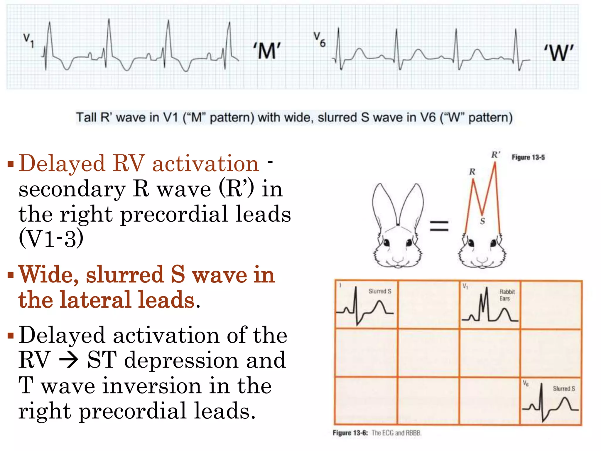 Delayed RV activation -
secondary R wave (R’) in
the right precordial leads
(V1-3)
Wide, slurred S wave in
the lateral leads.
Delayed activation of the
RV  ST depression and
T wave inversion in the
right precordial leads.
 