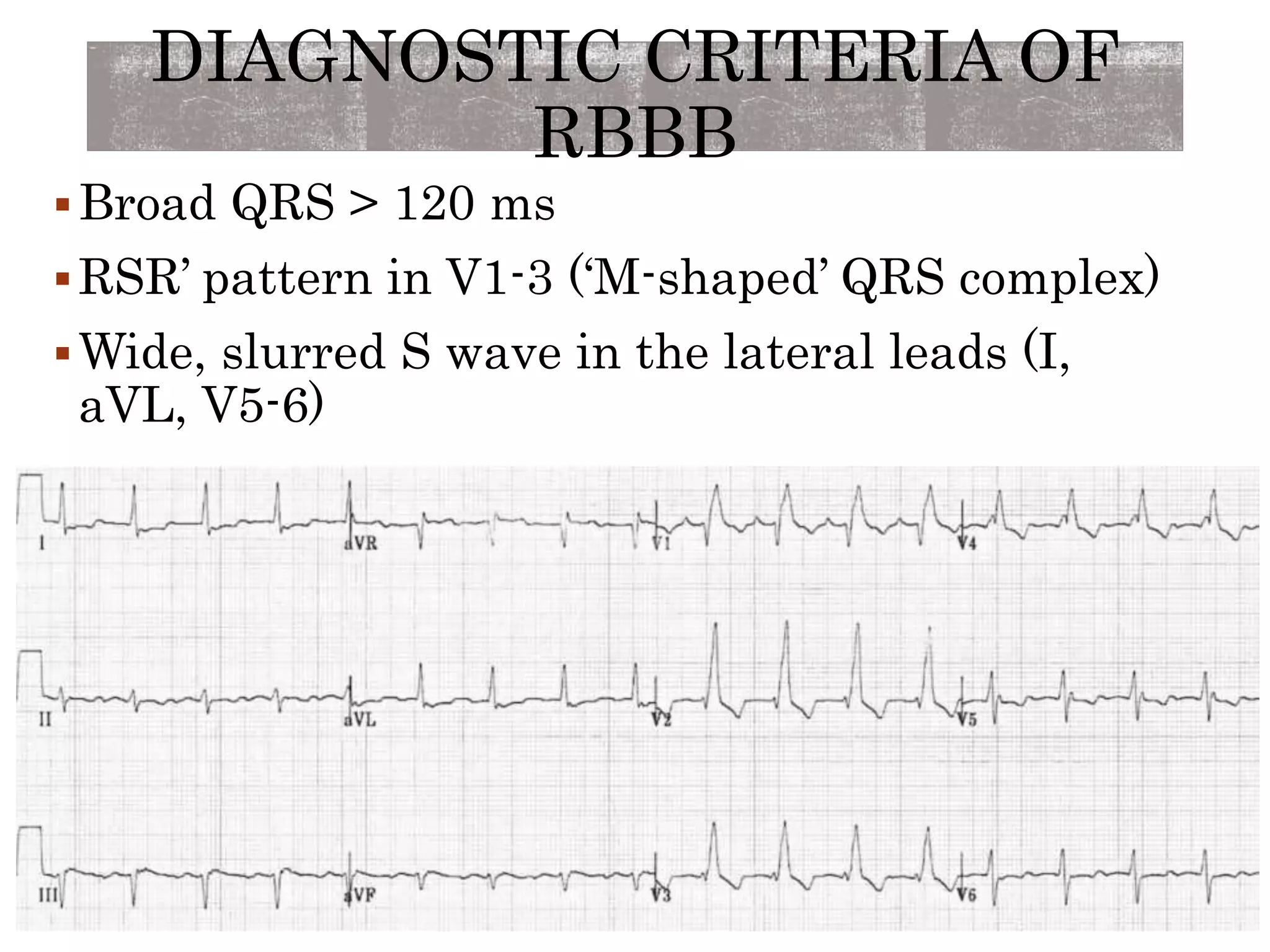 DIAGNOSTIC CRITERIA OF
RBBB
Broad QRS > 120 ms
RSR’ pattern in V1-3 (‘M-shaped’ QRS complex)
Wide, slurred S wave in the lateral leads (I,
aVL, V5-6)
 
