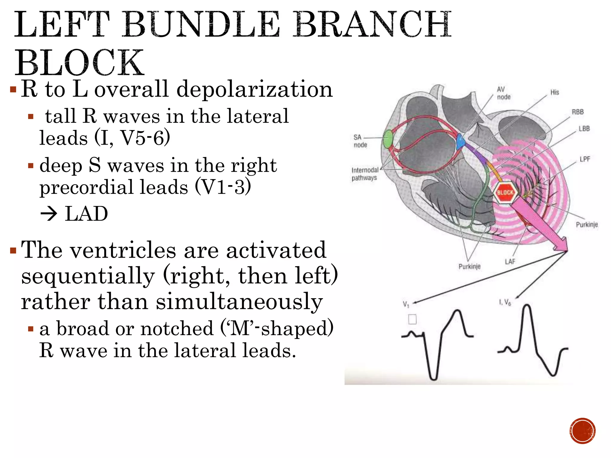 R to L overall depolarization
 tall R waves in the lateral
leads (I, V5-6)
 deep S waves in the right
precordial leads (V1-3)
 LAD
The ventricles are activated
sequentially (right, then left)
rather than simultaneously
 a broad or notched (‘M’-shaped)
R wave in the lateral leads.
 