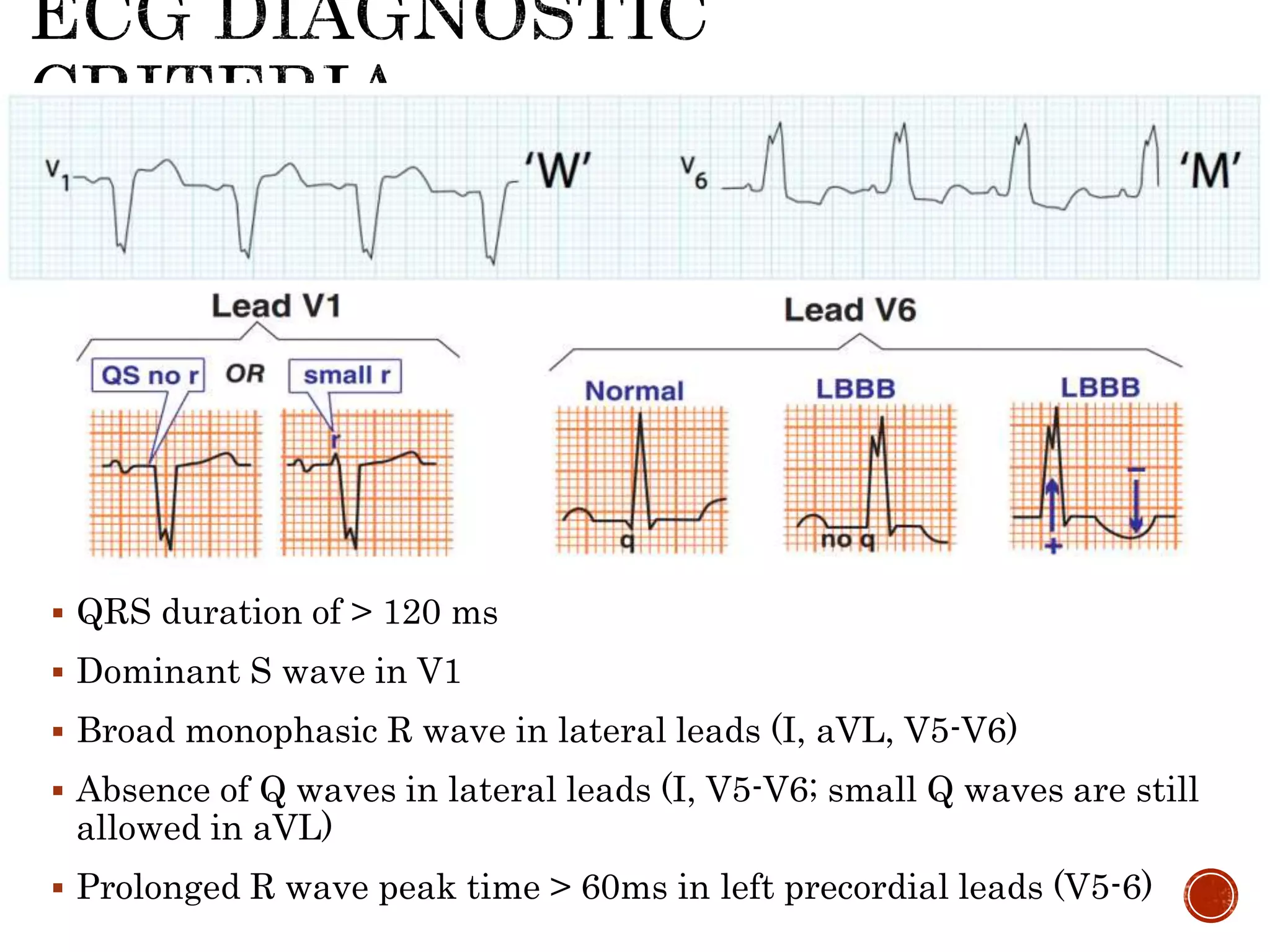  QRS duration of > 120 ms
 Dominant S wave in V1
 Broad monophasic R wave in lateral leads (I, aVL, V5-V6)
 Absence of Q waves in lateral leads (I, V5-V6; small Q waves are still
allowed in aVL)
 Prolonged R wave peak time > 60ms in left precordial leads (V5-6)
 