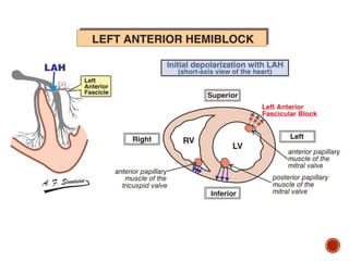 Left Anterior Fascicle