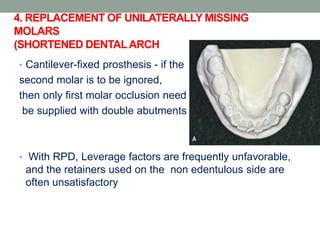 Occlusal Support Rpd Examination,diagnosis and treatment planning in rpd | PPTX