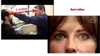 Red reflex
 