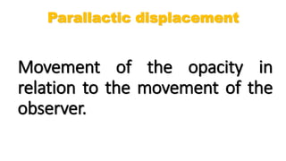 Movement of the opacity in
relation to the movement of the
observer.
Parallactic displacement
 