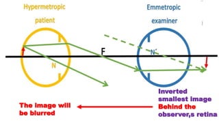 Inverted
smallest image
Behind the
observer,s retina
The image will
be blurred
 
