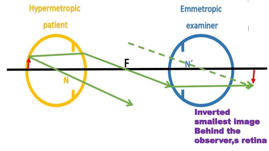 direct ophthalmoscope