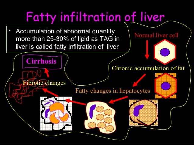 Fat Infiltration Of Liver 71