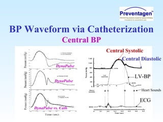 BP Waveform via Catheterization
Central BP
Central Systolic
Central Diastolic
LV-BP
ECG
Heart Sounds
DynaPulse
DynaPulse vs. Cath
DynaPulse
 