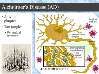Alzheimer’s Disease (AD)
• Amyloid
plaques
• Tau tangles
• Pyramidal
neurons
 