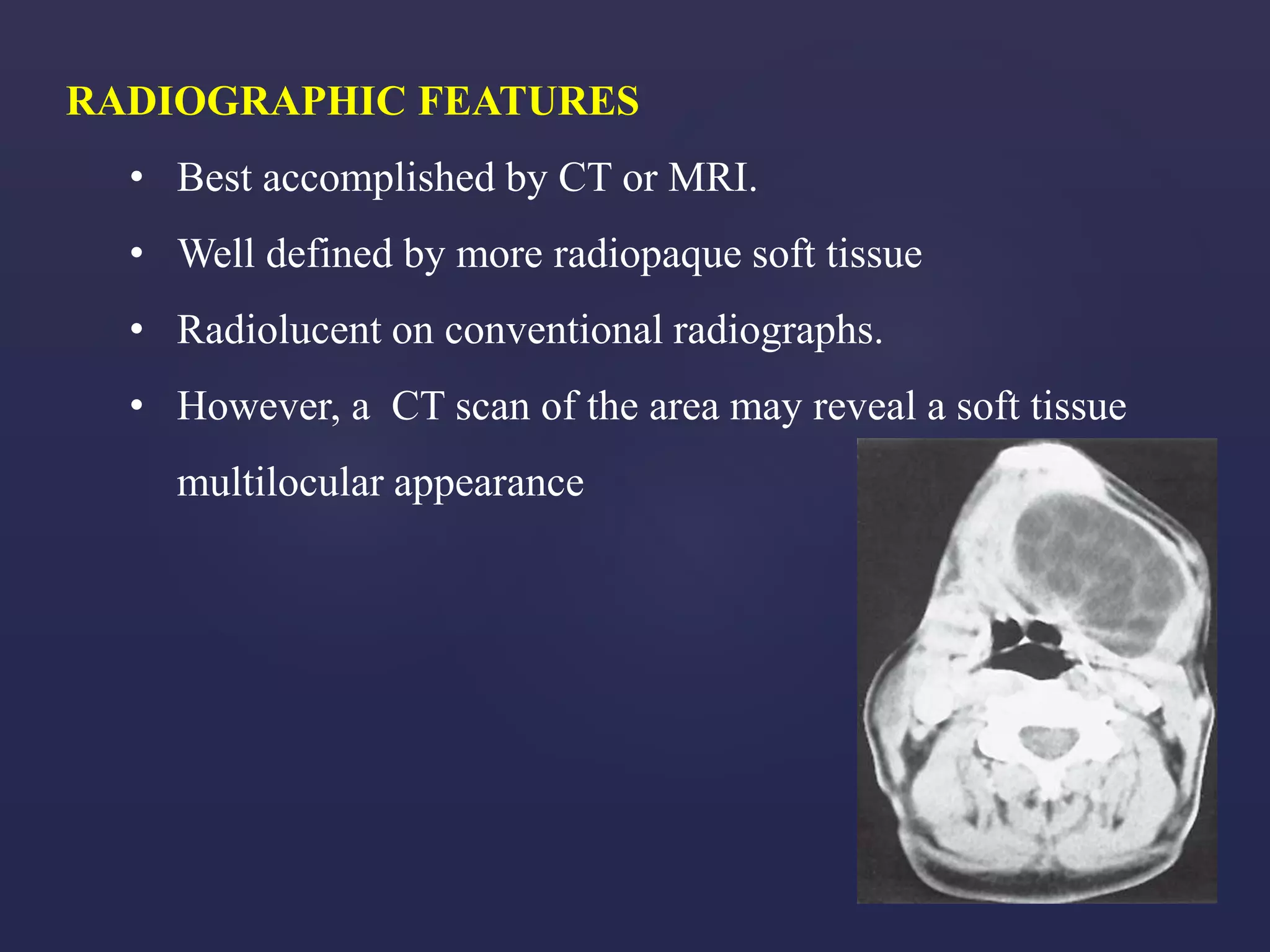 Hard Palate Anatomy And Fissural Maxillary Cysts