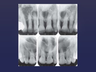 Fissural cysts of oral cavity | PPTX