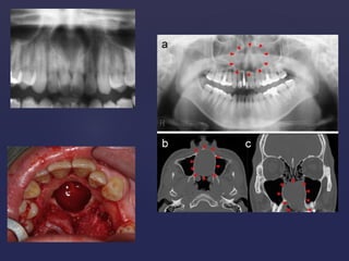 Fissural cysts of oral cavity | PPTX